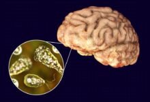 Naegleria fowleri