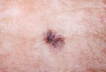 Melanoma Skin Cancer Has Reached an All-Time High in the UK